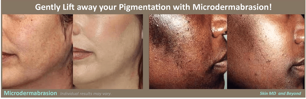 Before & After image of Sun Damaged Treatment Skin Frisco TX