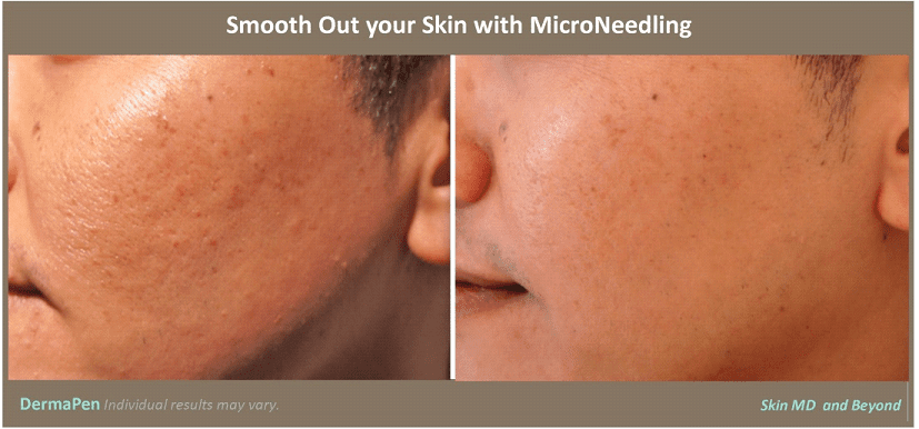 Before & After image of Microneedling Treatment Plano TX
