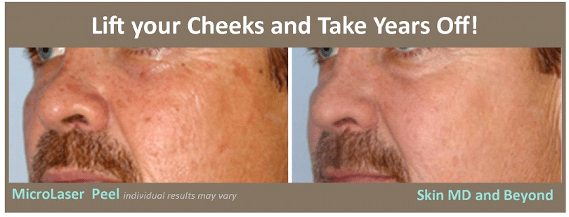 Before & After image of Microlaser Peel Treatment Plano TX