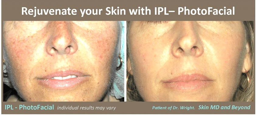Before & After image of Photofacial Rejuvenation Frisco TX 