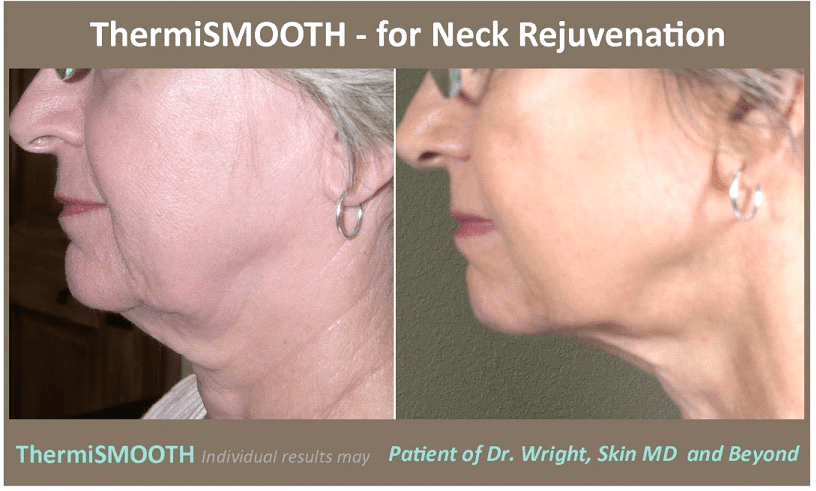 Before & After image of Neck Rejuvenation Frisco TX
