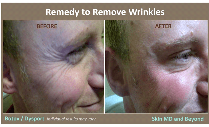 Before & After image of Wrinkles Removal Plano TX
