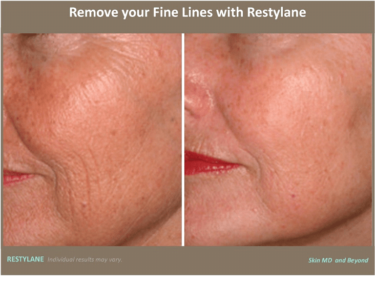 Before & After image of Restylane Frisco TX