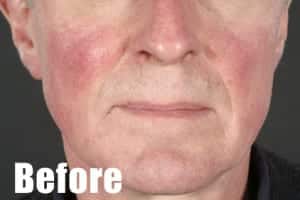 before treatment rosacea