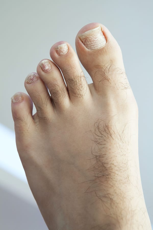 Do you have hair on your feet? Try Laser Hair Removal!