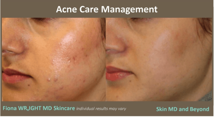 Before & After Image of Blu-U Light Therapy for Acne Frisco TX