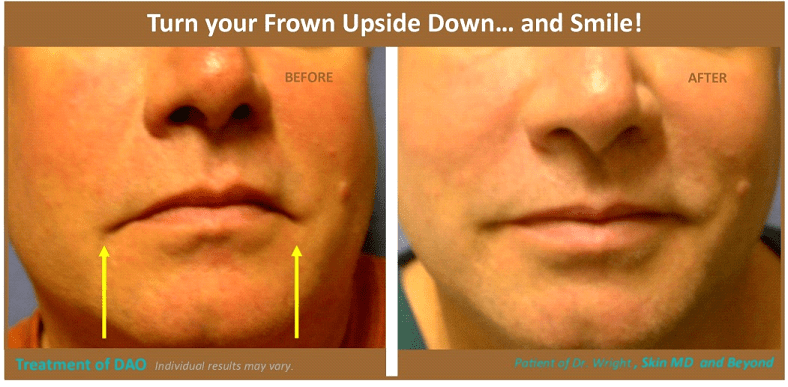 before and after photo of man's lower face after skin laxity treatment
