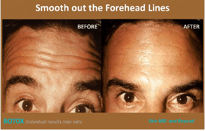 Before and after Forehead Lines Plano TX