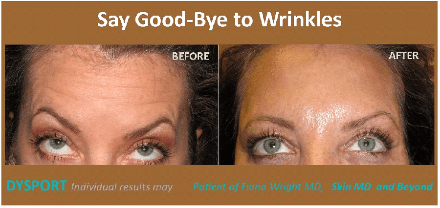 Before and after Forehead Lines Frisco TX