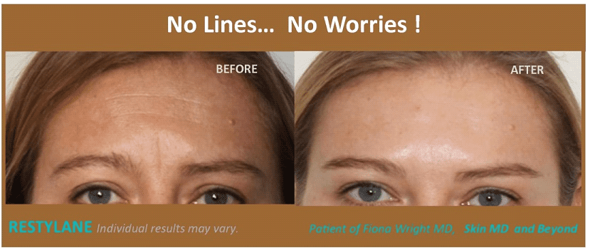 Before and after Wrinkle Reduction Frisco TX