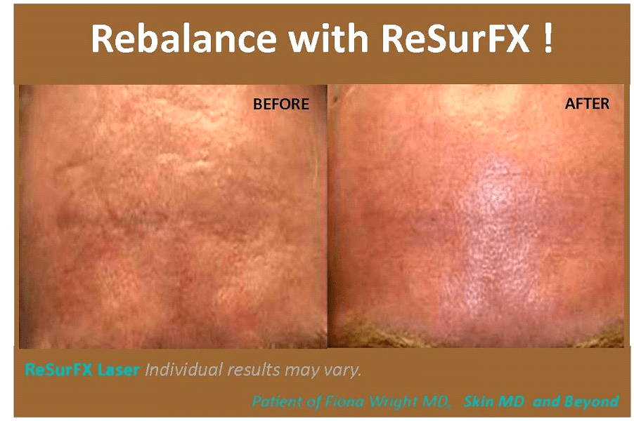 Before and after Wrinkle Reduction Plano TX
