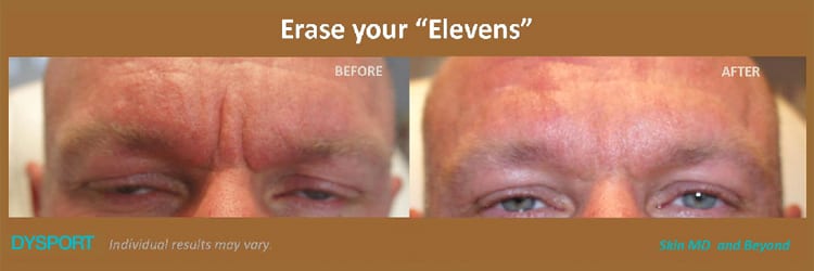 Frown Lines Plano TX