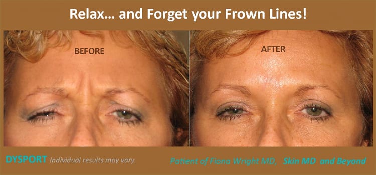 woman’s forehead before and after injectable frown line treatment
