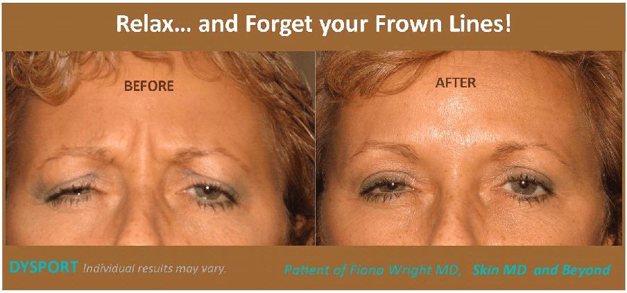 Before & After Dysport Frisco TX