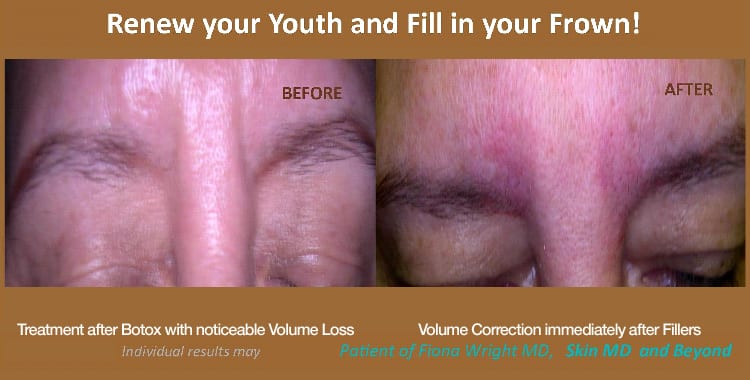 man's nose before and after injectable frown line treatment