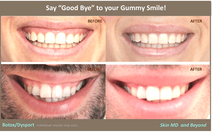 Before & After Botox Frisco TX