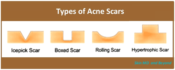 Acne Scars Types Plano TX