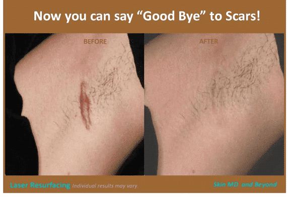 After & Before image of Scar Treatments Plano TX