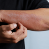 dermatitis on man hand, allergic rash dermatitis eczema skin of a patient.