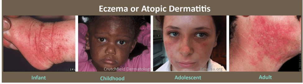 patients with eczema including eczema on foot, face, and neck