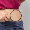 Women Show off the belly after birth. Stretch Marks on white background