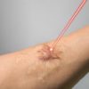 Man arm and laser beam during scar removal technology of skin treatment concept.