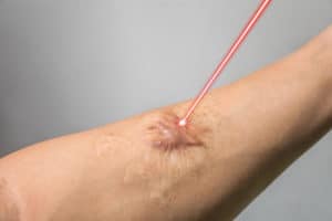 Man arm and laser beam during scar removal technology of skin treatment concept.