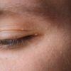 Milia (Milium) - pimples around eye on skin. Eyes of young man with small papillomas on eyelids or growths on skin.