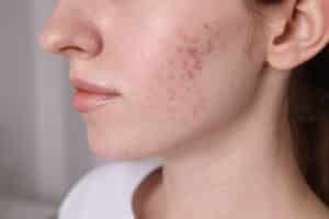 Close-up of a woman’s cheek with lingering dark acne marks and post-inflammatory hyperpigmentation.