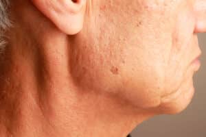 Close-up of facial brown spots and age-related pigmentation that may be evaluated for cryotherapy treatment.