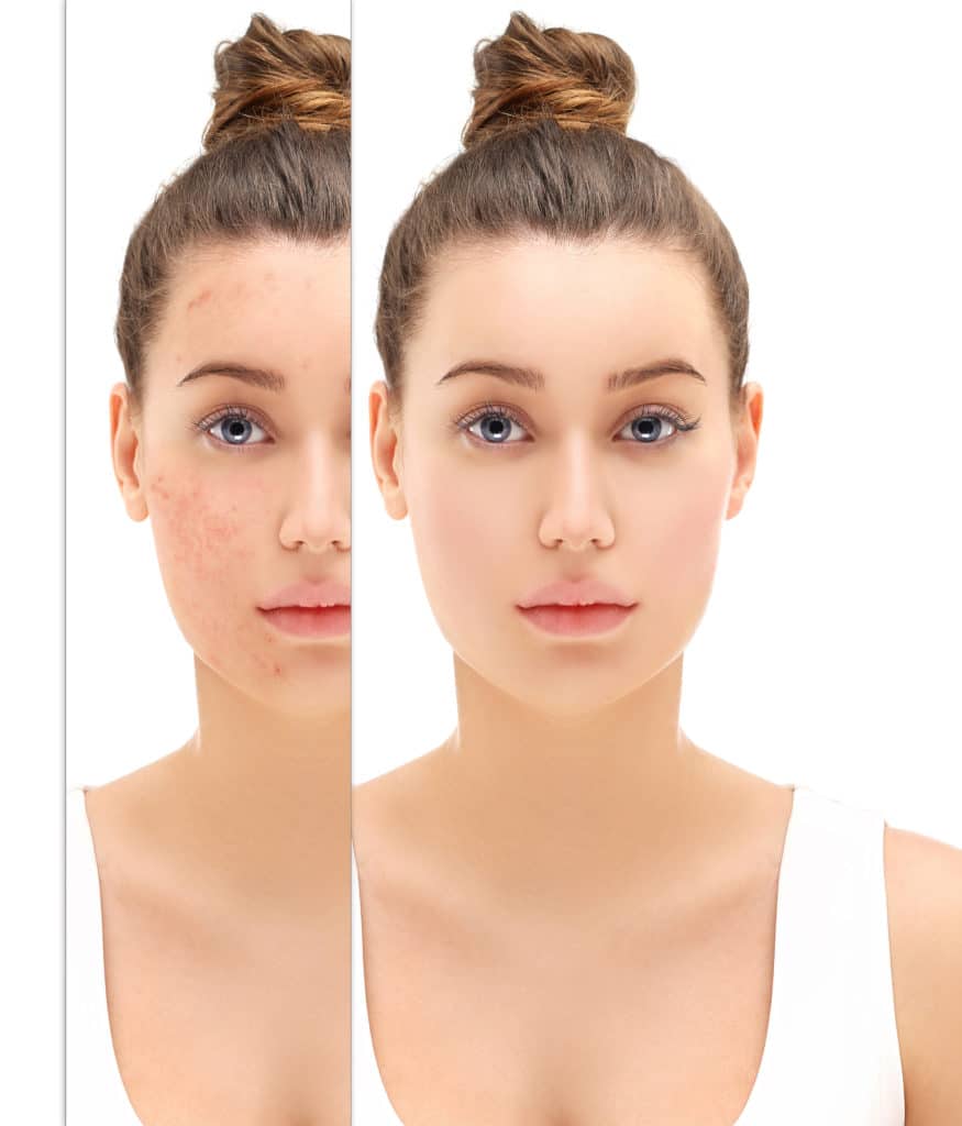 A before and after image of a woman that had chemical peel treatment.