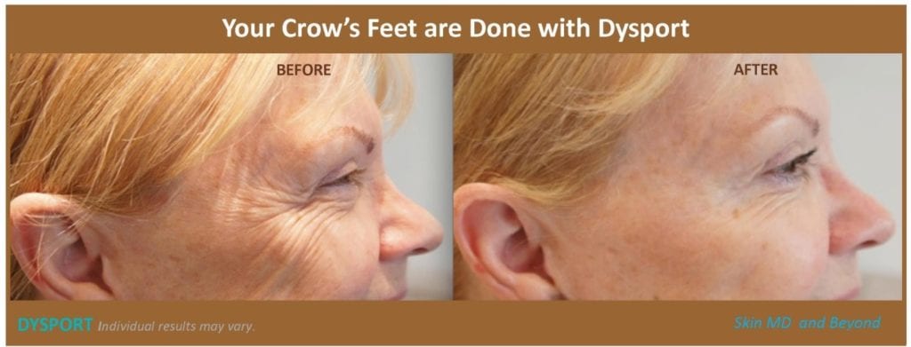 Crow's Feet Treatment with Dysport done by Dr. Wright