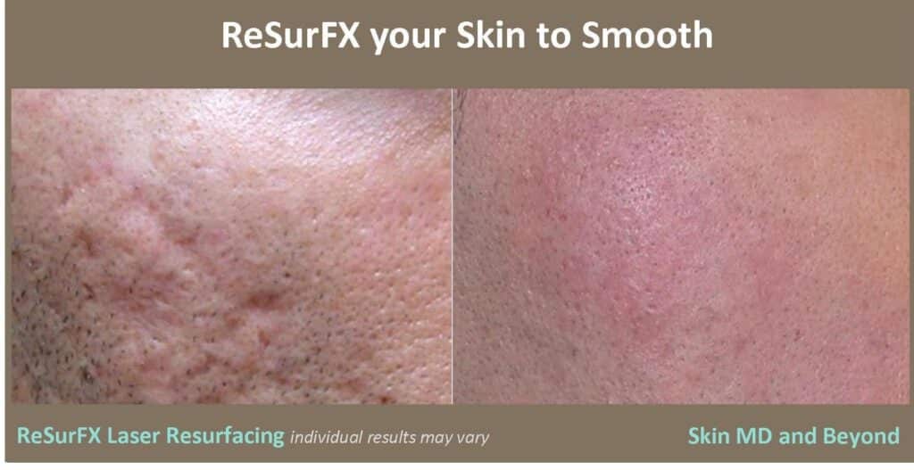 Laser Skin Resurfacing Plano TX