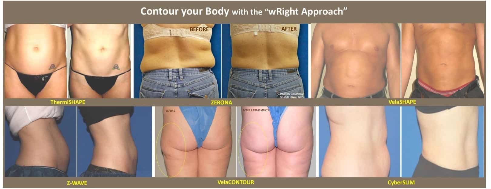 Cryo Slimming :: Non-Invasive Body Contouring Fat Reduction