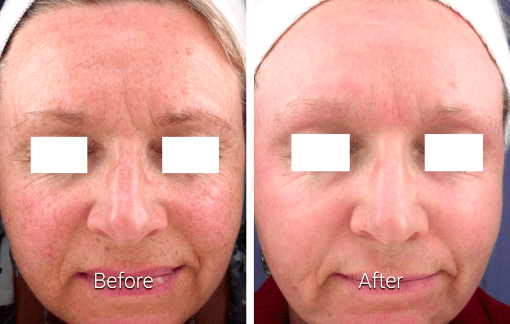 Laser Skin Resurfacing 