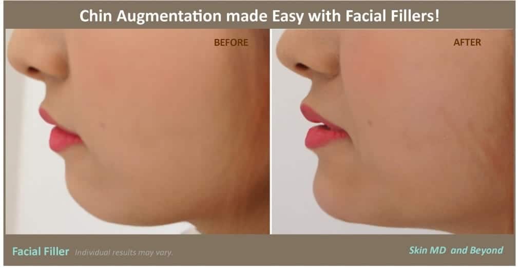 side view of young woman's chin before and after chin contouring