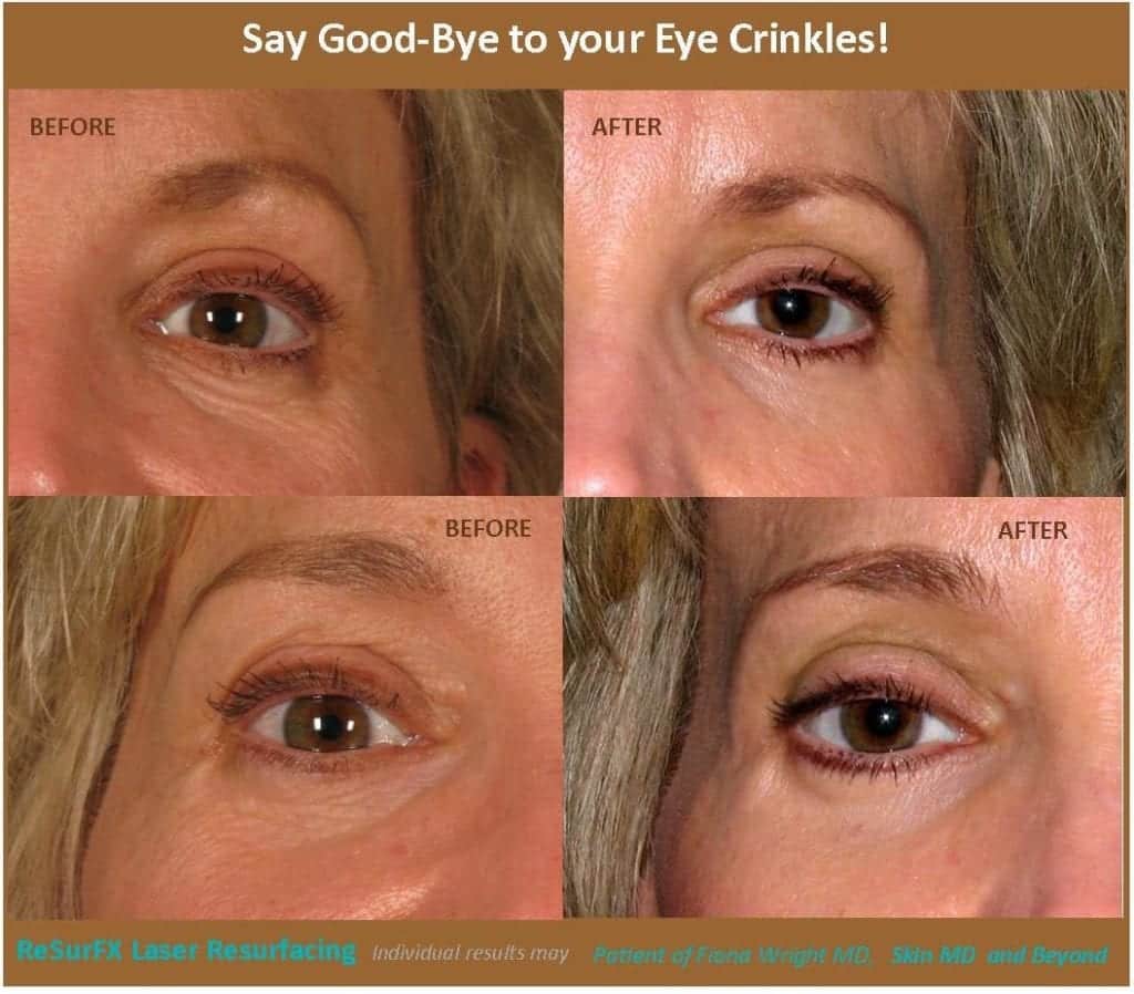 Under Eye Bags Treatments  Eye Rejuvenation Macon & Madison, GA