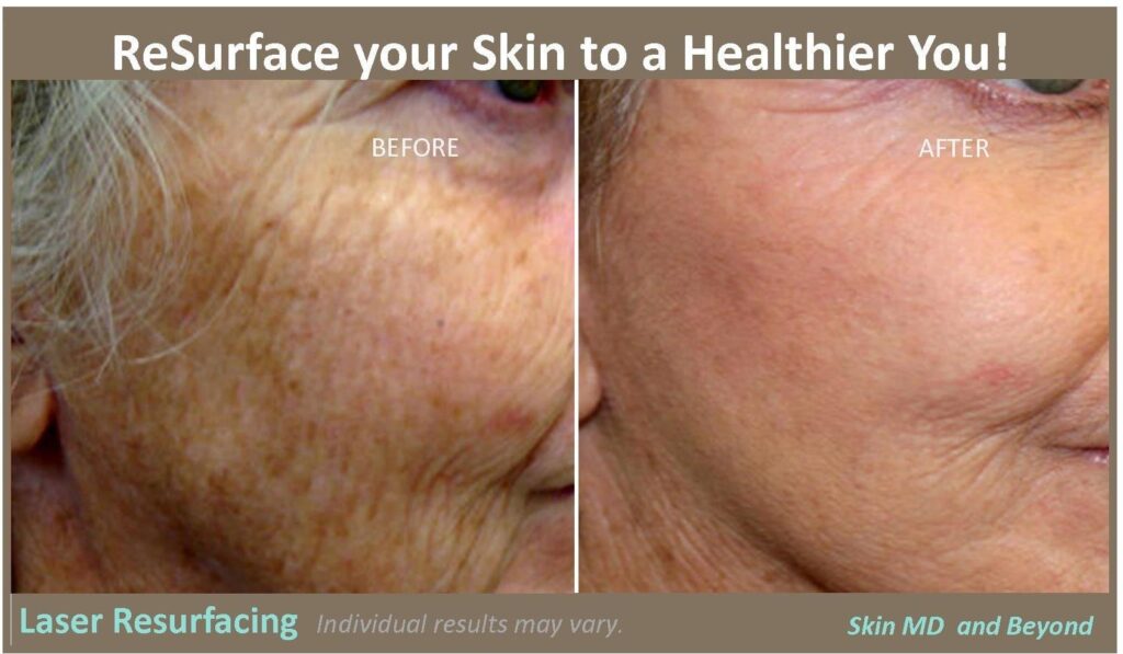 ReSurface Laser skin Plano TX