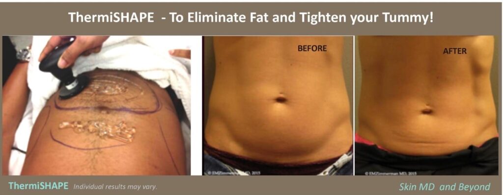 Little Elm, TX: Body Contouring - Immediate Results, Maximizing