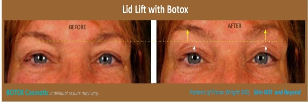 Botox /Dysport