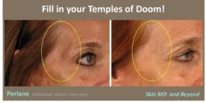 woman’s temple before and after temple rejuvenation with restylane