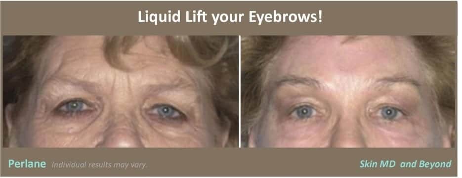 woman’s eyes and brow before and after liquid brow lift with restylane