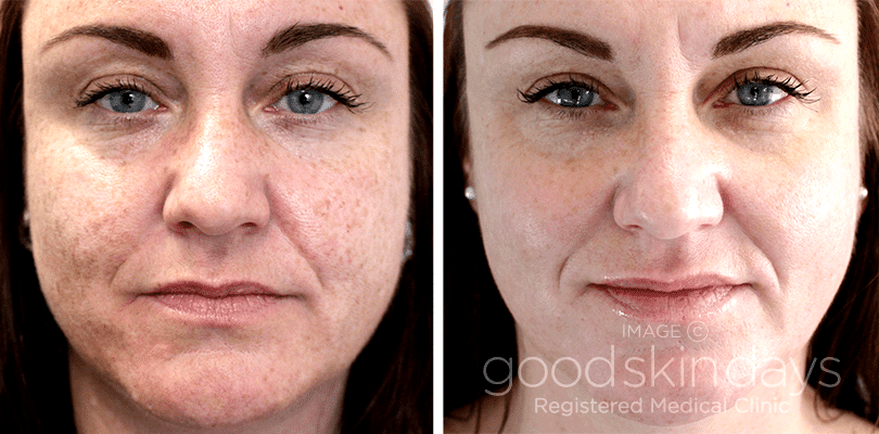 Laser Skin Resurfacing