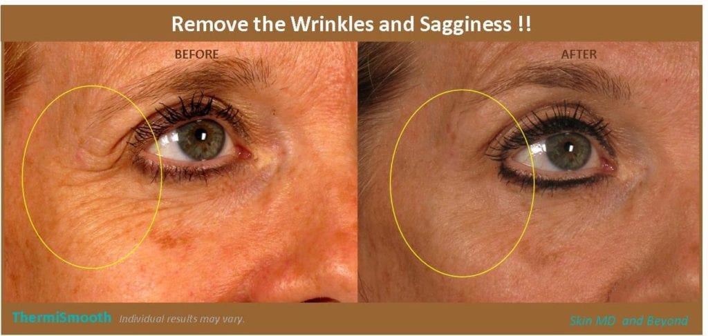 Under Eye Bags Treatments  Eye Rejuvenation Macon & Madison, GA