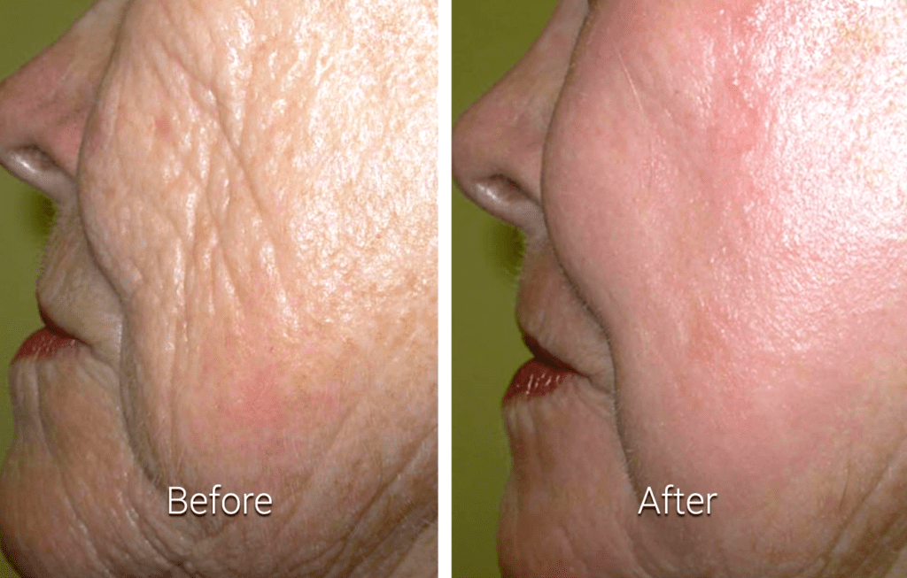 Facial Resurfacing 