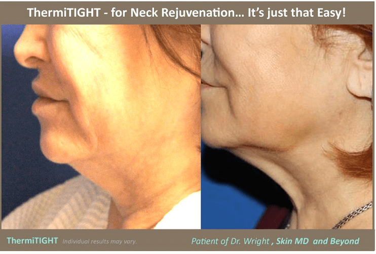 Before & After image of Jawline Rejuvenation Plano TX