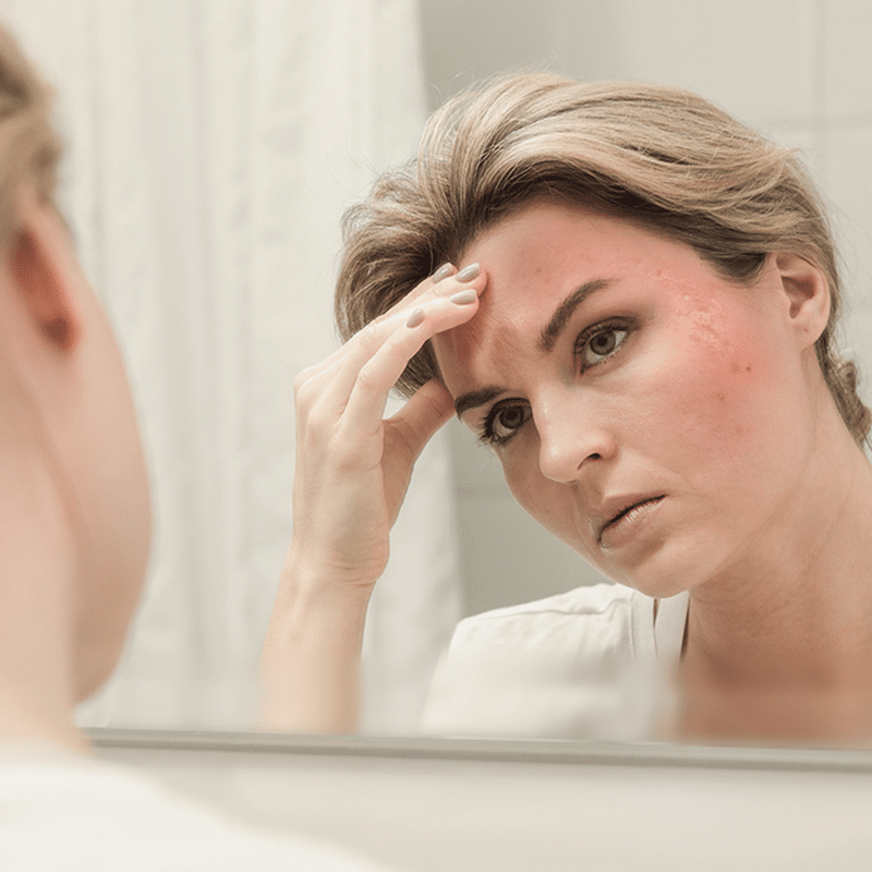Adult Acne: What’s Causing It - and How to Get It Under Control