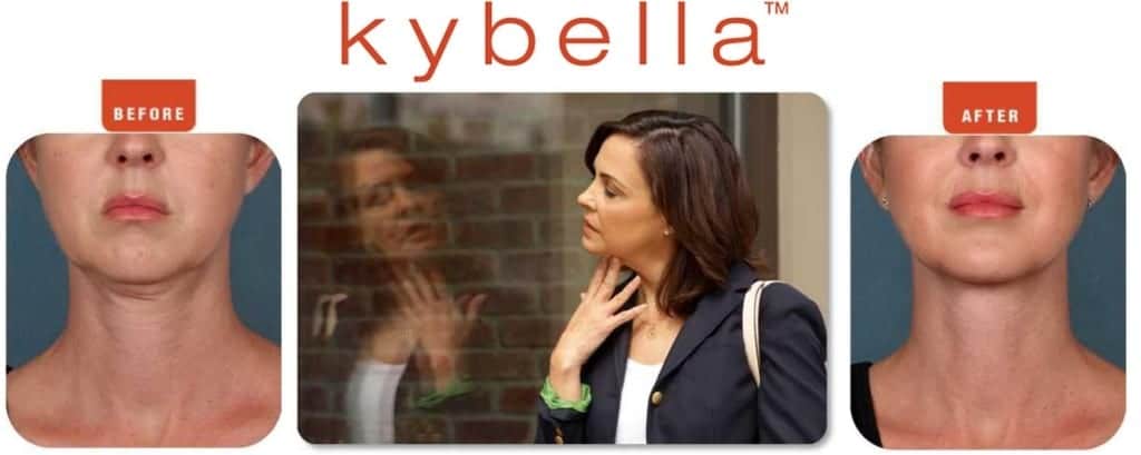 before and after of woman's chin after receiving Kybella, and separate photo of woman looking in reflection touching chin