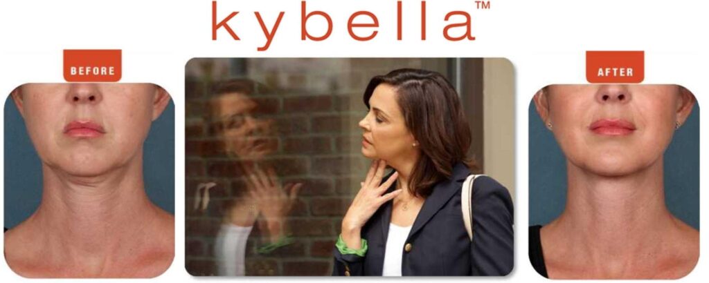 Kybella Plano TX