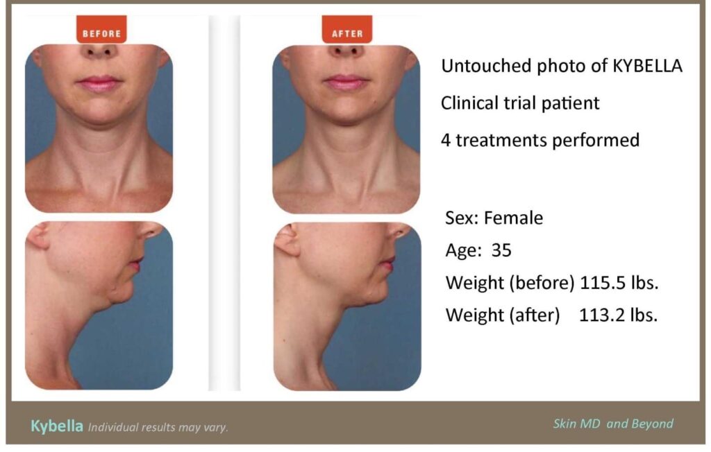 2 before and after photos showing disappearance of double chin and statistics about the woman